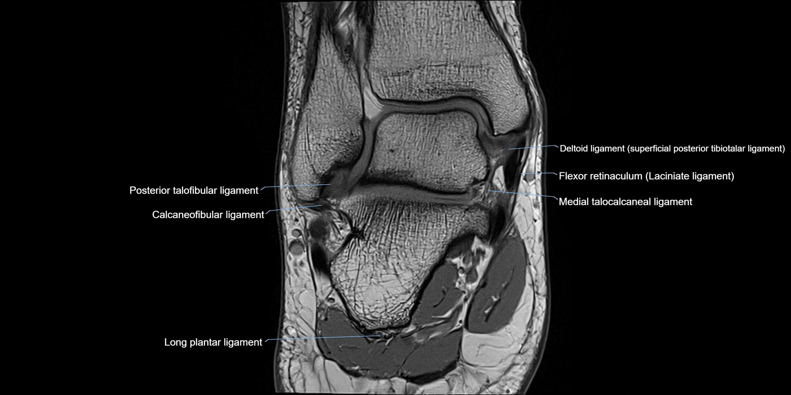 MRI Ankle coronal ligaments cross sectional anatomy 3T  radiology  image-img-00001-00014.webp